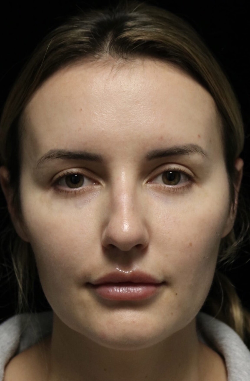 Beverly Hills Rhinoplasty Before & After Gallery - Patient 141036 - Image 3 Dr. Deepak Raj Dugar