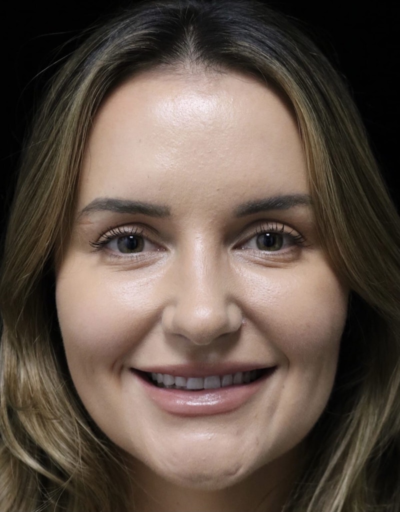Beverly Hills Rhinoplasty Before & After Gallery - Patient 141036 - Image 6 Dr. Deepak Raj Dugar