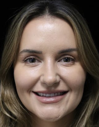 Beverly Hills Rhinoplasty Before & After Gallery - Patient 141036 - Image 6 Dr. Deepak Raj Dugar