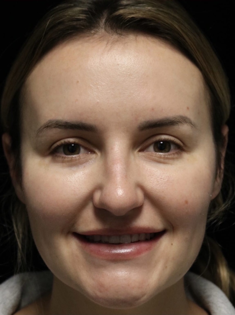 Beverly Hills Rhinoplasty Before & After Gallery - Patient 141036 - Image 5 Dr. Deepak Raj Dugar
