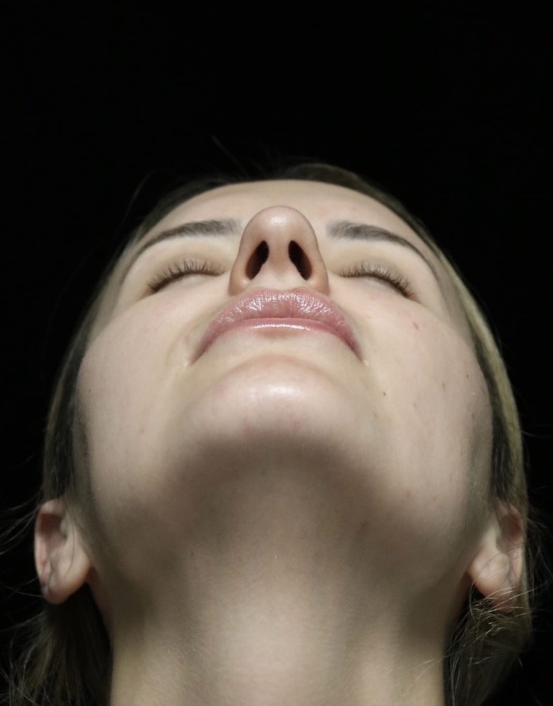 Beverly Hills Rhinoplasty Before & After Gallery - Patient 141036 - Image 7 Dr. Deepak Raj Dugar