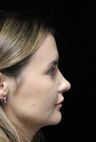 Beverly Hills Rhinoplasty Before & After Gallery - Patient 141036 - Image 2 Dr. Deepak Raj Dugar