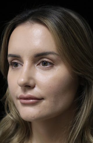 Beverly Hills Rhinoplasty Before & After Gallery - Patient 141036 - Image 10 Dr. Deepak Raj Dugar