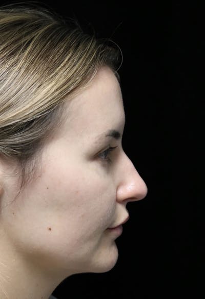 Beverly Hills Rhinoplasty Before & After Gallery - Patient 141036 - Image 1 Dr. Deepak Raj Dugar
