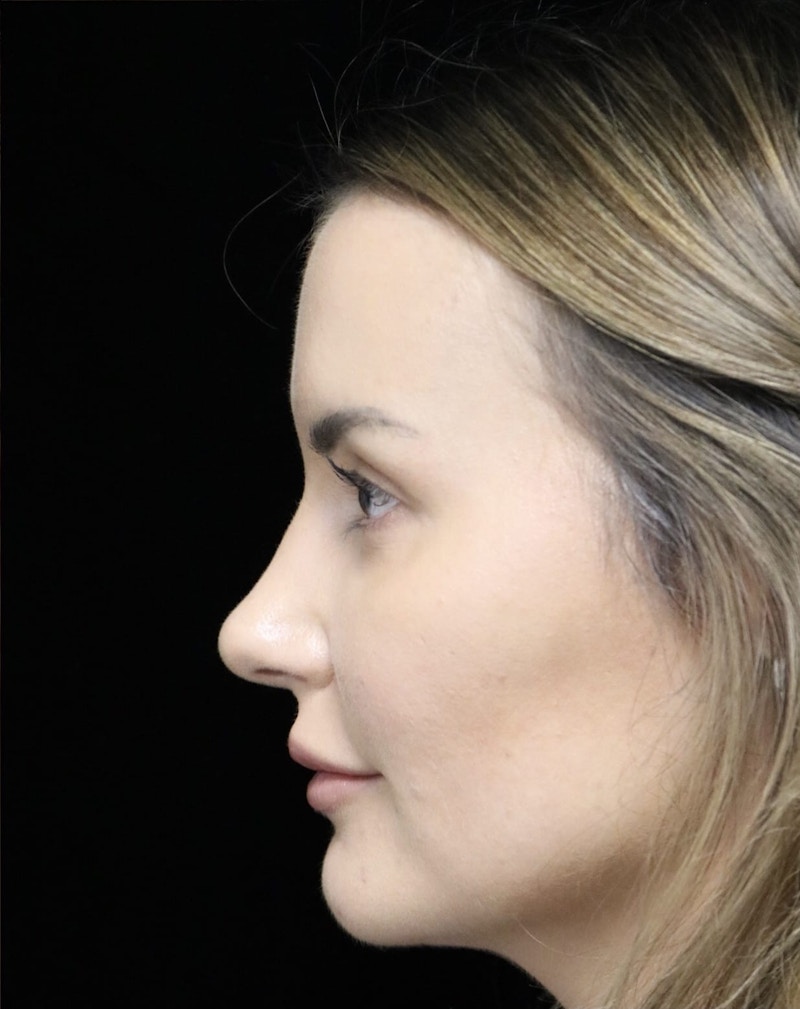 Beverly Hills Rhinoplasty Before & After Gallery - Patient 141036 - Image 12 Dr. Deepak Raj Dugar