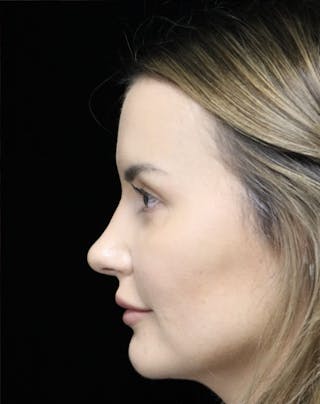 Beverly Hills Rhinoplasty Before & After Gallery - Patient 141036 - Image 12 Dr. Deepak Raj Dugar