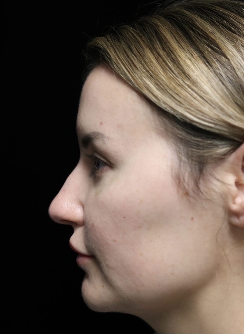 Beverly Hills Rhinoplasty Before & After Gallery - Patient 141036 - Image 11 Dr. Deepak Raj Dugar