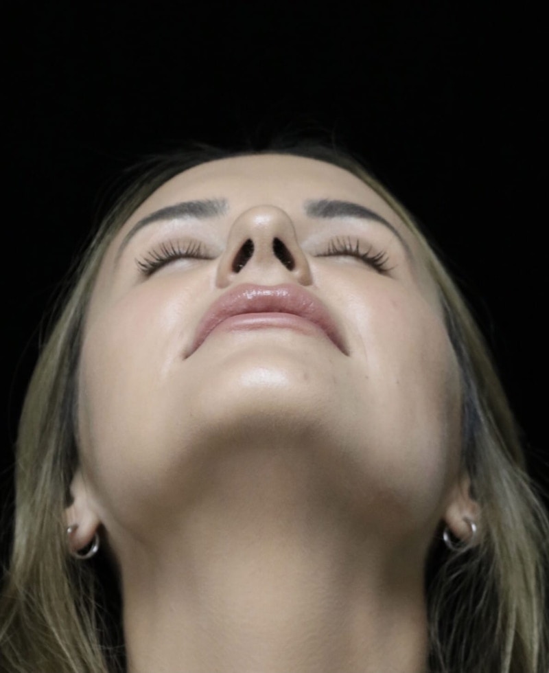 Beverly Hills Rhinoplasty Before & After Gallery - Patient 141036 - Image 8 Dr. Deepak Raj Dugar