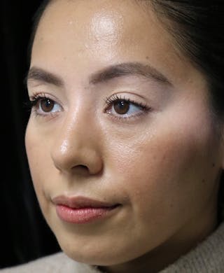 Beverly Hills Rhinoplasty Before & After Gallery - Patient 412880 - Image 14 Dr. Deepak Raj Dugar