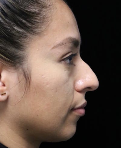 Beverly Hills Rhinoplasty Before & After Gallery - Patient 412880 - Image 1 Dr. Deepak Raj Dugar