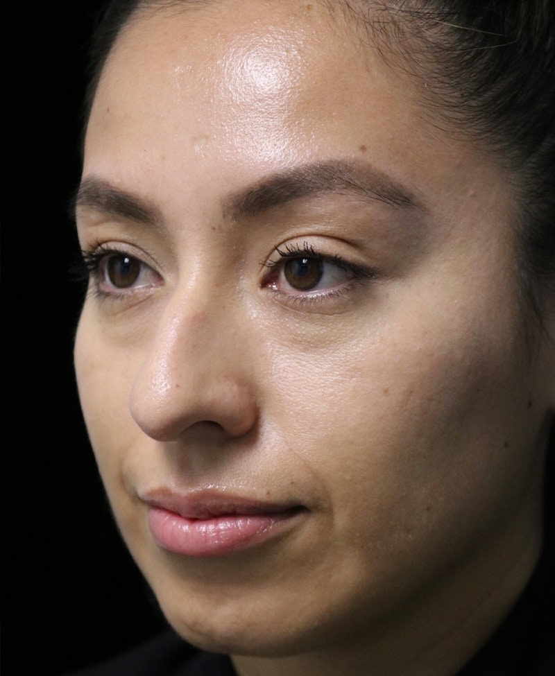 Beverly Hills Rhinoplasty Before & After Gallery - Patient 412880 - Image 13 Dr. Deepak Raj Dugar