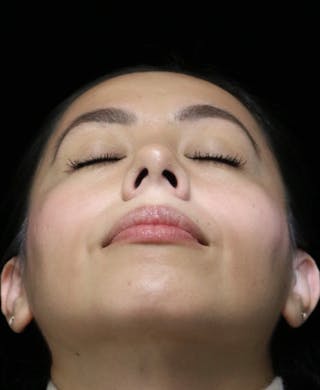 Beverly Hills Rhinoplasty Before & After Gallery - Patient 412880 - Image 10 Dr. Deepak Raj Dugar