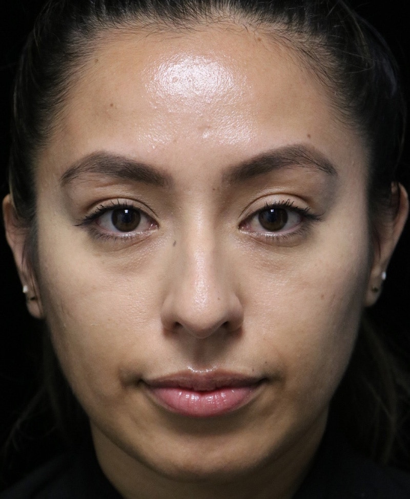 Beverly Hills Rhinoplasty Before & After Gallery - Patient 412880 - Image 7 Dr. Deepak Raj Dugar
