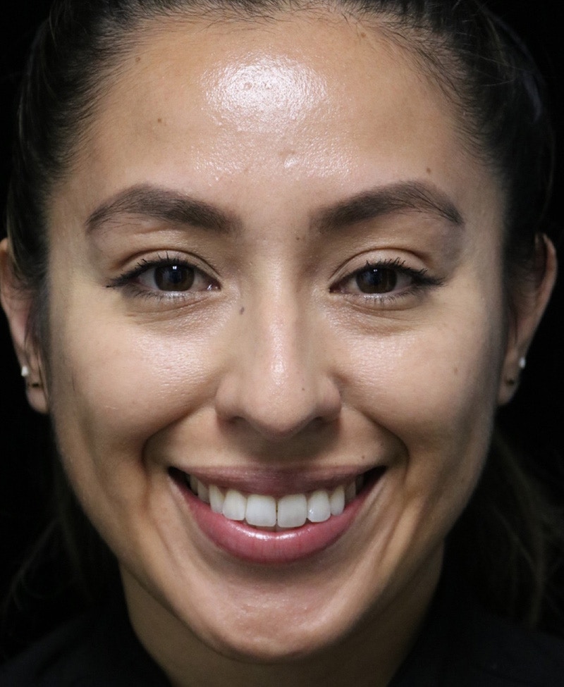 Beverly Hills Rhinoplasty Before & After Gallery - Patient 412880 - Image 5 Dr. Deepak Raj Dugar