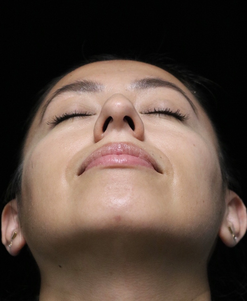 Beverly Hills Rhinoplasty Before & After Gallery - Patient 412880 - Image 9 Dr. Deepak Raj Dugar