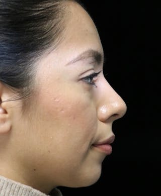 Beverly Hills Rhinoplasty Before & After Gallery - Patient 412880 - Image 2 Dr. Deepak Raj Dugar