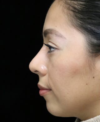 Beverly Hills Rhinoplasty Before & After Gallery - Patient 412880 - Image 12 Dr. Deepak Raj Dugar