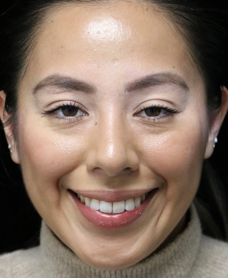 Beverly Hills Rhinoplasty Before & After Gallery - Patient 412880 - Image 6 Dr. Deepak Raj Dugar