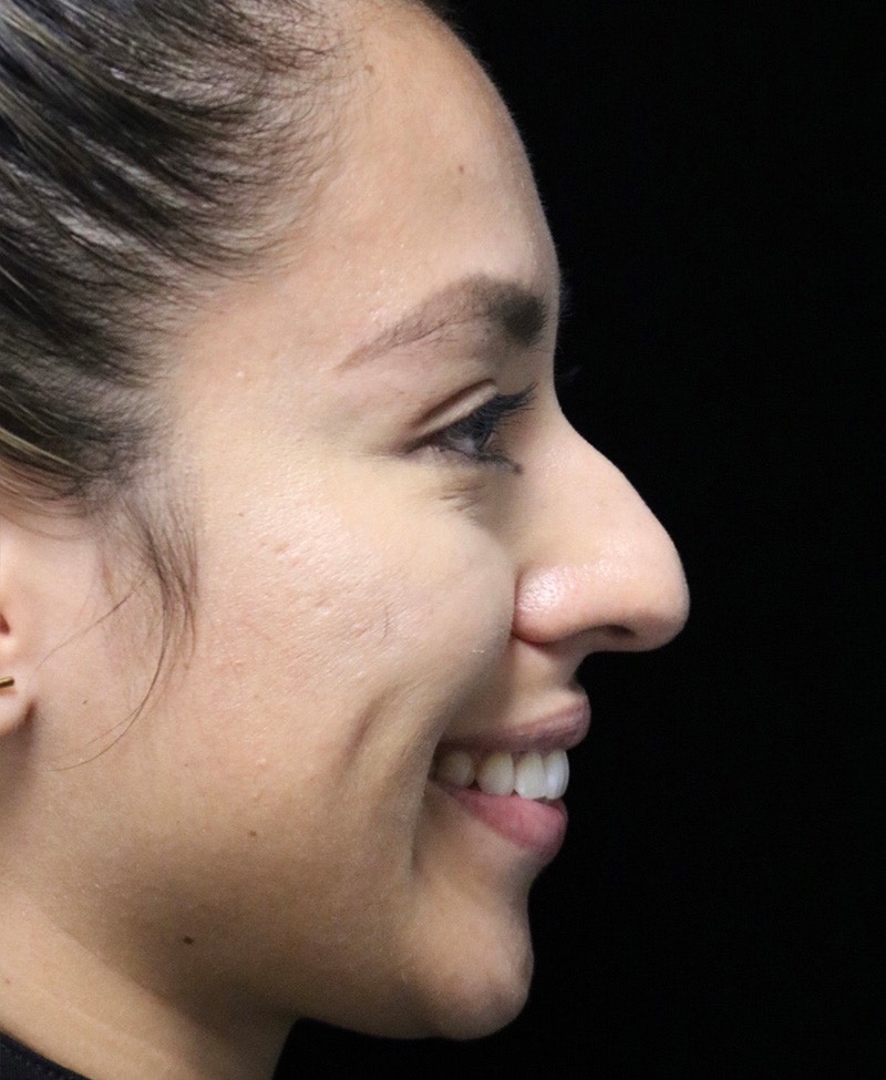 Beverly Hills Rhinoplasty Before & After Gallery - Patient 412880 - Image 3 Dr. Deepak Raj Dugar