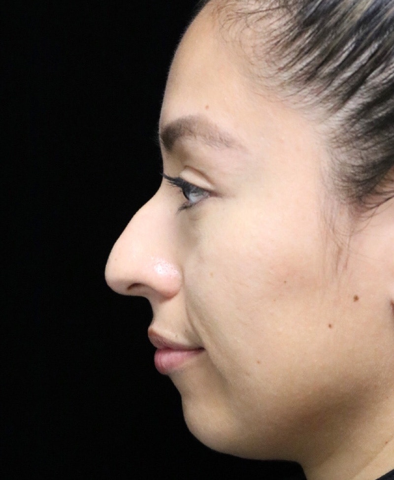 Beverly Hills Rhinoplasty Before & After Gallery - Patient 412880 - Image 11 Dr. Deepak Raj Dugar