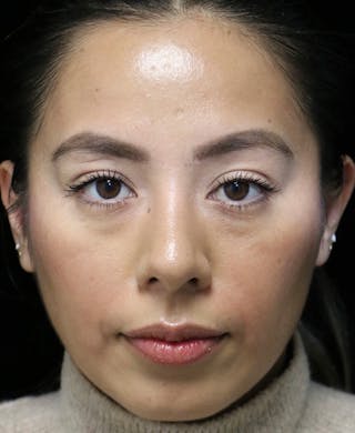 Beverly Hills Rhinoplasty Before & After Gallery - Patient 412880 - Image 8 Dr. Deepak Raj Dugar