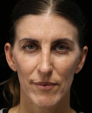 Beverly Hills Rhinoplasty Before & After Gallery - Patient 360246 - Image 6 Dr. Deepak Raj Dugar