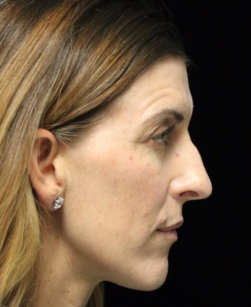 Beverly Hills Rhinoplasty Before & After Gallery - Patient 360246 - Image 1 Dr. Deepak Raj Dugar