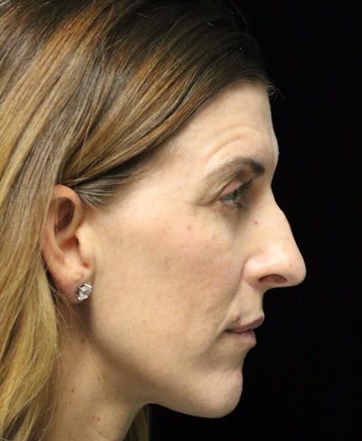 Beverly Hills Rhinoplasty Before & After Gallery - Patient 360246 - Image 1 Dr. Deepak Raj Dugar