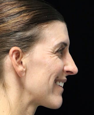 Beverly Hills Rhinoplasty Before & After Gallery - Patient 360246 - Image 4 Dr. Deepak Raj Dugar