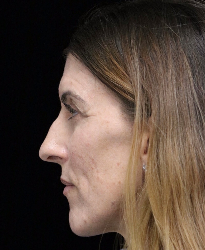 Beverly Hills Rhinoplasty Before & After Gallery - Patient 360246 - Image 9 Dr. Deepak Raj Dugar