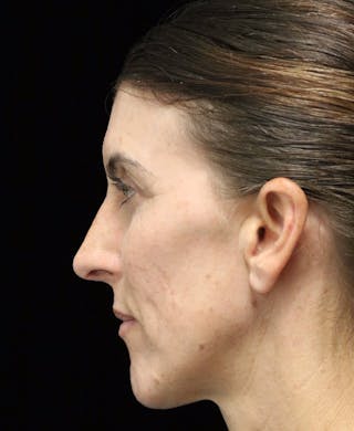 Beverly Hills Rhinoplasty Before & After Gallery - Patient 360246 - Image 10 Dr. Deepak Raj Dugar