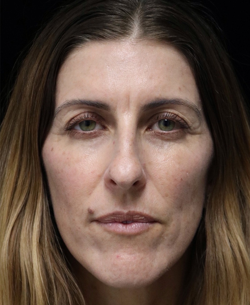 Beverly Hills Rhinoplasty Before & After Gallery - Patient 360246 - Image 5 Dr. Deepak Raj Dugar