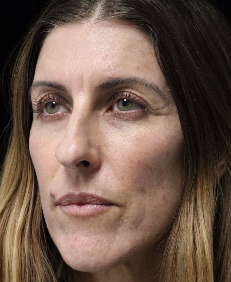 Beverly Hills Rhinoplasty Before & After Gallery - Patient 360246 - Image 7 Dr. Deepak Raj Dugar