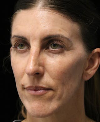 Beverly Hills Rhinoplasty Before & After Gallery - Patient 360246 - Image 8 Dr. Deepak Raj Dugar