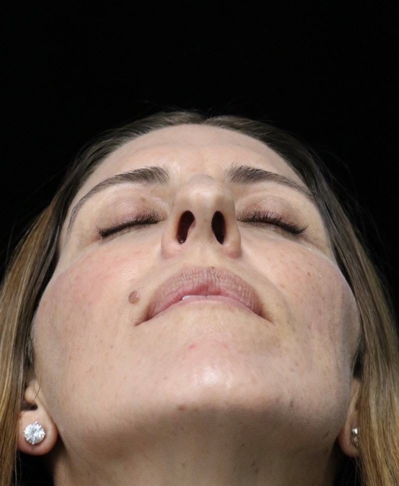 Beverly Hills Rhinoplasty Before & After Gallery - Patient 360246 - Image 12 Dr. Deepak Raj Dugar