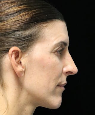 Beverly Hills Rhinoplasty Before & After Gallery - Patient 360246 - Image 2 Dr. Deepak Raj Dugar
