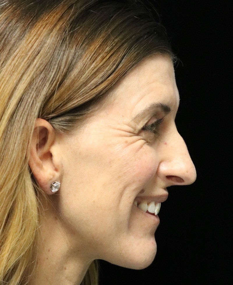 Beverly Hills Rhinoplasty Before & After Gallery - Patient 360246 - Image 3 Dr. Deepak Raj Dugar