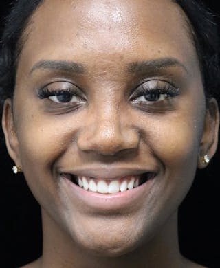 Beverly Hills Rhinoplasty Before & After Gallery - Patient 846242 - Image 6 Dr. Deepak Raj Dugar