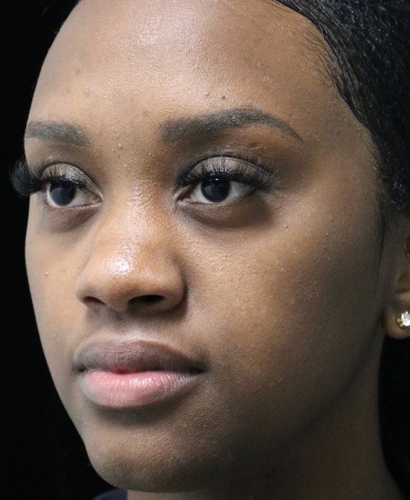 Beverly Hills Rhinoplasty Before & After Gallery - Patient 846242 - Image 7 Dr. Deepak Raj Dugar