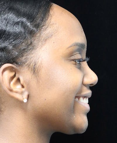 Beverly Hills Rhinoplasty Before & After Gallery - Patient 846242 - Image 1 Dr. Deepak Raj Dugar
