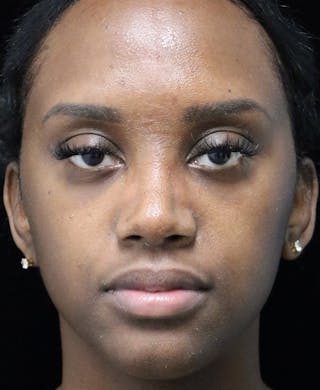 Beverly Hills Rhinoplasty Before & After Gallery - Patient 846242 - Image 4 Dr. Deepak Raj Dugar