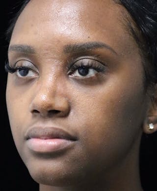 Beverly Hills Rhinoplasty Before & After Gallery - Patient 846242 - Image 8 Dr. Deepak Raj Dugar