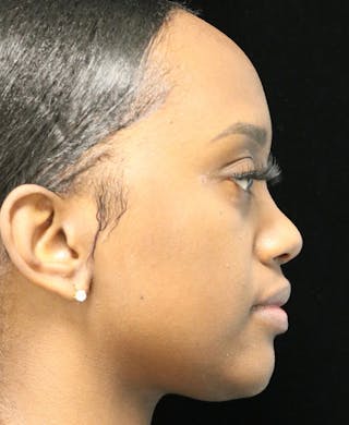 Beverly Hills Rhinoplasty Before & After Gallery - Patient 846242 - Image 2 Dr. Deepak Raj Dugar