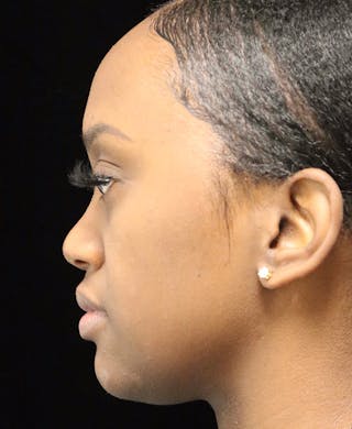 Beverly Hills Rhinoplasty Before & After Gallery - Patient 846242 - Image 10 Dr. Deepak Raj Dugar