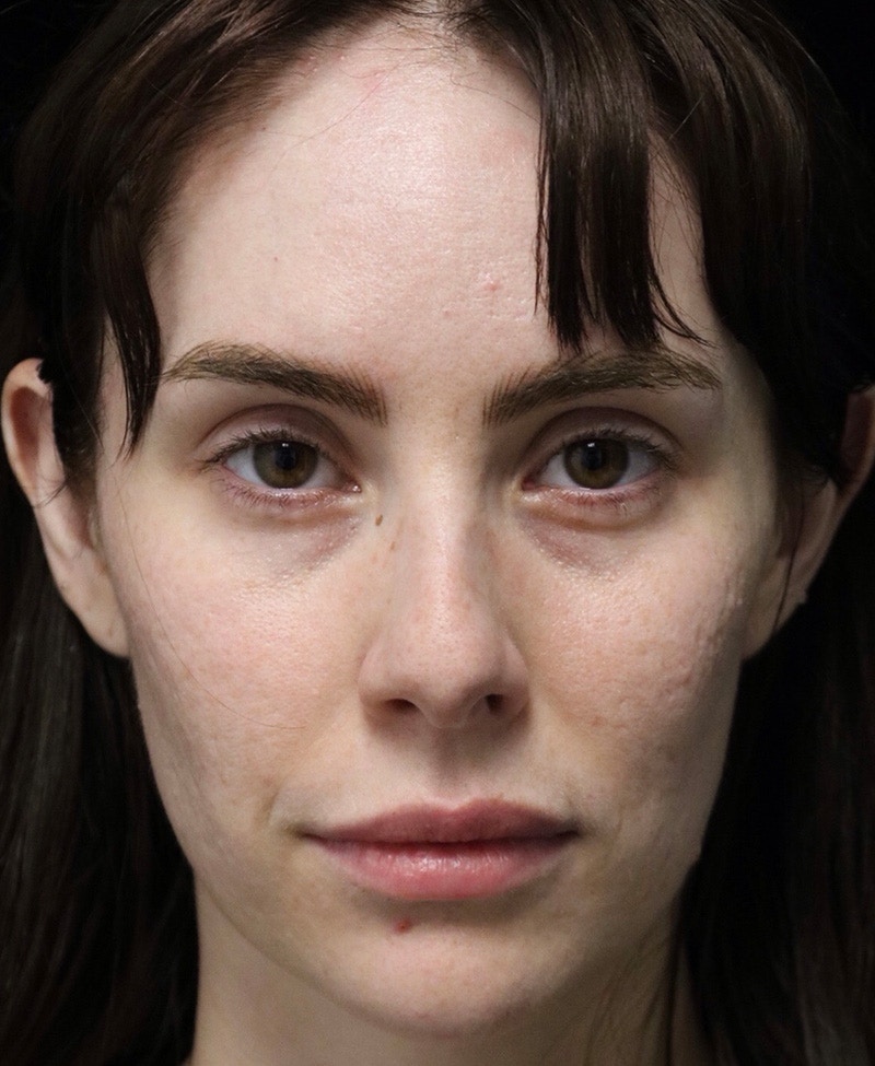 Beverly Hills Rhinoplasty Before & After Gallery - Patient 111829 - Image 5 Dr. Deepak Raj Dugar