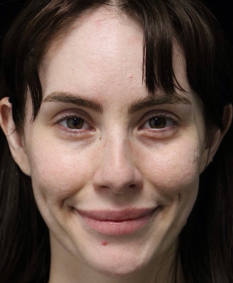 Beverly Hills Rhinoplasty Before & After Gallery - Patient 111829 - Image 7 Dr. Deepak Raj Dugar
