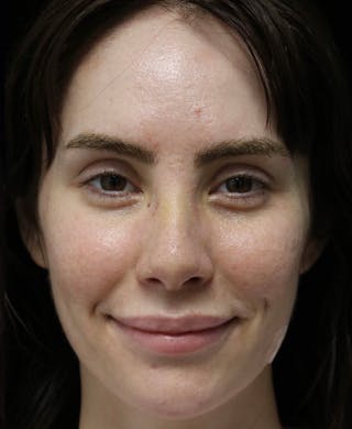 Beverly Hills Rhinoplasty Before & After Gallery - Patient 111829 - Image 8 Dr. Deepak Raj Dugar