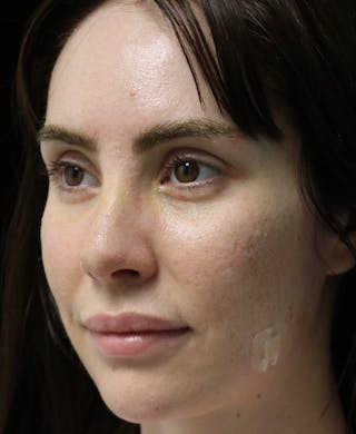 Beverly Hills Rhinoplasty Before & After Gallery - Patient 111829 - Image 10 Dr. Deepak Raj Dugar