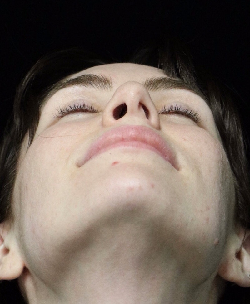 Beverly Hills Rhinoplasty Before & After Gallery - Patient 111829 - Image 13 Dr. Deepak Raj Dugar