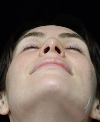 Beverly Hills Rhinoplasty Before & After Gallery - Patient 111829 - Image 14 Dr. Deepak Raj Dugar